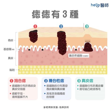 多痣的人|為什麼臉上的痣越來越多？皮膚科醫師解析長痣原因、。